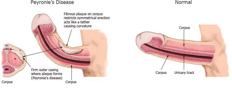 peyronie's disease treatment in Kelowna to straighten the shaft